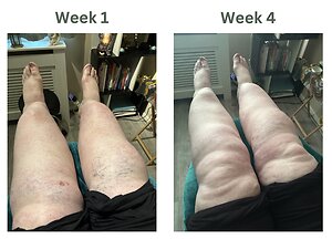 RLD, Reflexology Lymph Drainage. Therapy. Adele Graves lipoedema 4 weeks