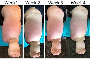 RLD, Reflexology Lymph Drainage. Therapy. Ceilia 4 week treatment 