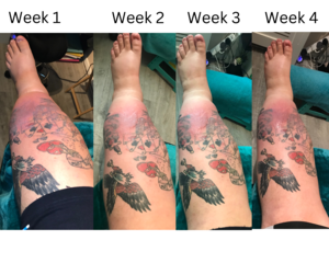 RLD, Reflexology Lymph Drainage. Therapy. Chris 4 week treatment 