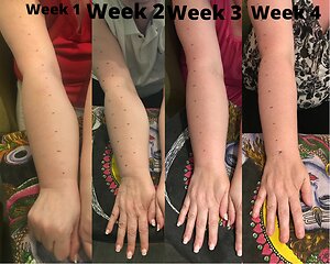 RLD, Reflexology Lymph Drainage. Therapy. 4 week RLD treatment