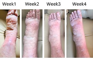 RLD, Reflexology Lymph Drainage. Therapy. Maureen 4 week treatment 