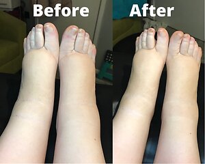 RLD, Reflexology Lymph Drainage. Therapy. Dianne Bargh 