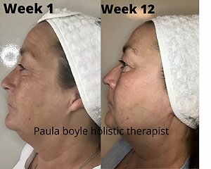 Zone Face Lift. Jackie before & after