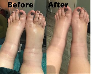 RLD, Reflexology Lymph Drainage. Therapy. RLD foot treatment 