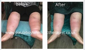 RLD, Reflexology Lymph Drainage. Therapy. Debbie Twell 