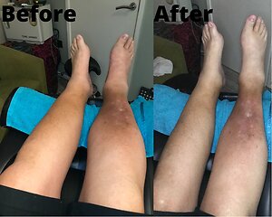 RLD, Reflexology Lymph Drainage. Therapy. Alan 