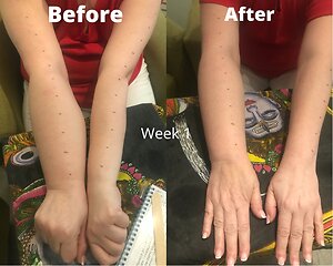 RLD, Reflexology Lymph Drainage. Therapy. Helen RLD week 1