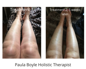 RLD, Reflexology Lymph Drainage. Therapy. Susanna legs