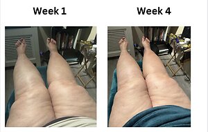 RLD, Reflexology Lymph Drainage. Therapy. Vicky hughes lipoedema