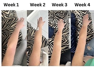 RLD, Reflexology Lymph Drainage. Therapy. Ruth lymphoedema 4 weeks