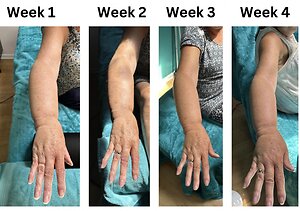 RLD, Reflexology Lymph Drainage. Therapy. Teresa lymphoedema 4 weeks