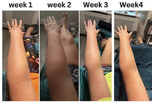 RLD, Reflexology Lymph Drainage. Therapy. Sally lymphoedema 4 weeks