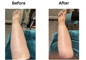 RLD, Reflexology Lymph Drainage. Therapy. Andrea Oedema 1 week